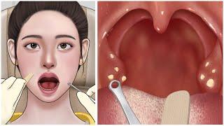 [ASMR] Cause of bad breath! Tonsil stone removal animation