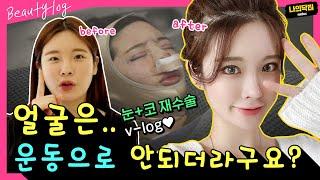 포샵으로도 이렇게는 못해! 눈코재수술 브이로그 1탄! 한달차 쌩얼로 보여줄게! - 나닥 뷰티로그