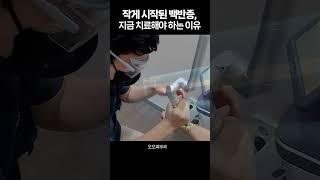 하얀 반점, 그냥 두지 마세요! | 백반증 진단·팔라스 치료 | 현풍 피부과 오오피부과