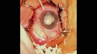 AIOCMT3 2024 - VT152 - Prof. Dr. Manisha Nada - Clearing the Haze: Surgical Approach to Unilateral..