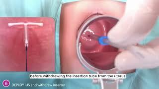 Inserting AVIBELA hormonal IUD (English)