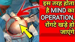 Brain Operation in 3D || Brain surgery || Technical Gujju