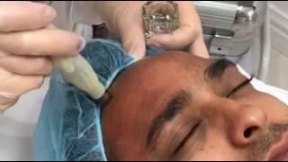 Dermapen Micro-needling Treatment Sky Clinic