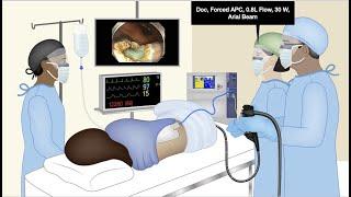 HCC 1475-31  Argon Plasma Coagulation