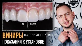 Показания для установки виниров. Что можно исправить с помощью виниров?