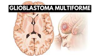 Inside Glioblastoma Multiforme: A Journey into the Deadliest Brain Tumor