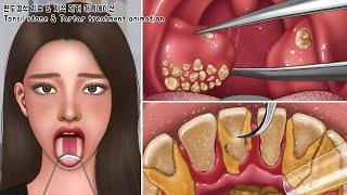 ASMR Extreme Tonsil Stone Treatment & Giant Tartar Removal Animation | White Tongue