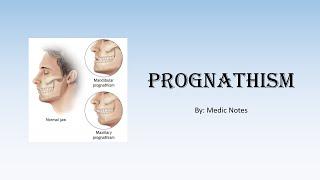 Pathophysiology of prognathism in acromegaly