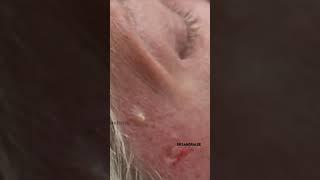 POPPING ‘Seattle-Tacoma‘s’  | Dr. Pimple Popper #drpimplepopper #steatocystoma #shorts