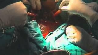 Caesarean Section: Step 4 - Delivery of the baby,  placenta