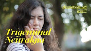 Trigeminal Neuralgia and Acupuncture