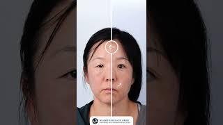 Double Eyelid Surgery: Transforming Hooded Eyelids for a Brighter, Youthful Look