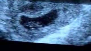 Ultrasound at 8 weeks 3 days gestation