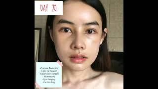 FACE CONTOURING, RHINOPLASTY, EYES SURGERY, FAT GRAFTING REAL REVIEW