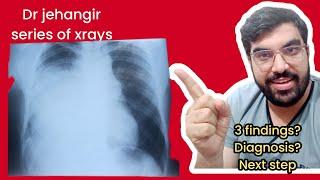 CHEST XRAY OF OPACITY IN RIGHT LUNG|XRAY OF PNEUMONIA|XRAY OF LUNG CANCER|MASS ON CHEST XRAY|NEET PG