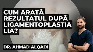 Rezultatul dupa ligamentoplastia LIA (Reconstructia Ligamentului Incrucisat Anterior)Dr AHMAD ALQADI