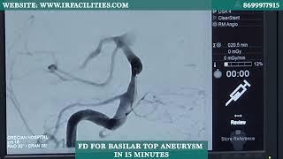 FD for Basilar Top Aneurysm: 15-Minute Precision by Dr. Sandeep Sharma