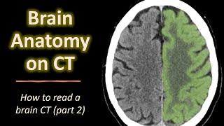 How to read a brain CT (part 2): Brain anatomy on CT