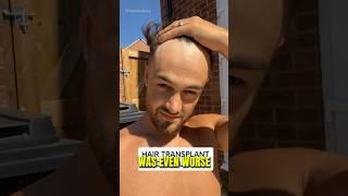 The Best Hair Transplant Transformations