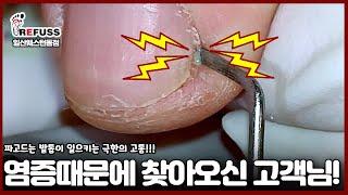 파고드는 발톱이 일으키는 극한의 고통! 염증때문에 오셨어요ㅠㅠ #레푸스 #일산레푸스 #내성발톱 #무좀발톱 #ingrown_toenail #일산내성발톱 #일산무좀발톱 #발톱