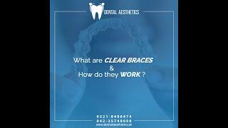 Clear Braces - Dental Aesthetics