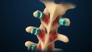 Scoliosis | Scoliosis Surgery | Nucleus Health