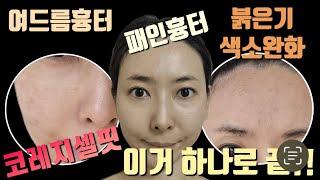 여드름흉터, 패인흉터, 붉은기 완화 레이저‼️ 자극없는 관리추천‼️ 코레지셀핏 시술 상세후기⁉️