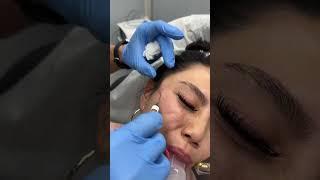 Under Eyes & Temple Filler Treatments by Dr. TJ Tsay - Ageless MD