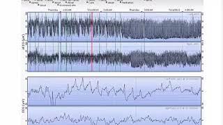 aEEG Case Study Infant with Recurring Apnea Robert White