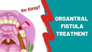 Oroantral Fistula | Treatment Options | ORAL SURGERY