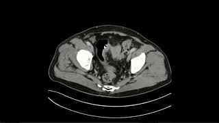 Carcinoma de sigmóide / Carcinoma of sigmoid