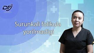 Surunkali folikula yorilmasligi