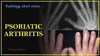 Psoriatic arthritis: Radiology Short notes