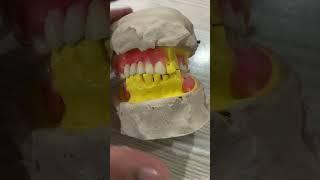 Partial denture setup #umairtoothfairy #dentist #satisfying #dentistry #shorts @Umairazeem8553