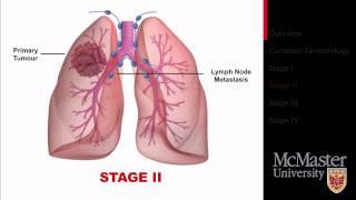 Lung Cancer: Staging Presentation