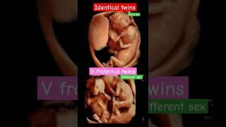 Twins, identical (same gender) vs Fraternal twins, 4D ulutrasound #baby #ultrasound #shorts