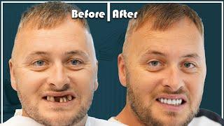 Simon from UK did dental implants in Turkey and got an AMAZING RESULT!