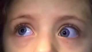 Sindrome de Brown