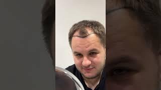 Hair Transplant in Turkey | 4000 Grafts Hair Transplant  before and after operation