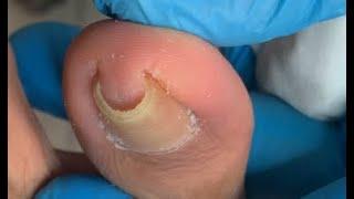 C Shape toenails treatment