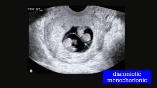 Topic 20: Multifetal Gestation