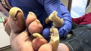 Unbelievable!  Toenails so long and painful that patient cannot walk!