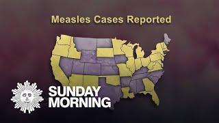 As measles cases increase, experts warn against vaccine skepticism