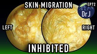 EP 72 : SKIN MIGRATION : INHIBITED BY HEARING AIDS : CAUSES MALFUNCTION 4K/HD