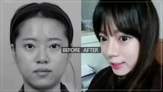 Korean Plastic Surgery Before and After, Double Eyelids, Rhinoplasty, id hospital review