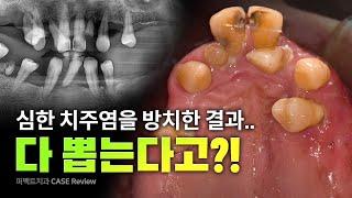 50대 남성 치주염 전악임플란트 | 발치 임플란트 00개