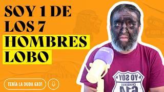 Me llaman "HOMBRE LOBO": ¿Por qué nací así?