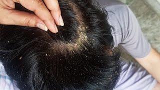 Scratching Dry Dandruff