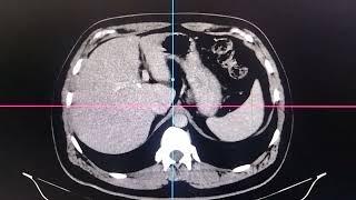 CT SCAN WHOLE ABDOMEN INTERPRETATIONS