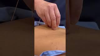 ASMR: Relaxing Chinese Tuina Massage and Acupuncture #shorts